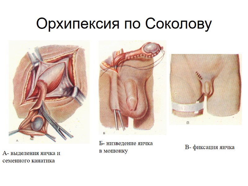 Орхипексия по Соколову А- выделения яичка и  семенного канатика Б- низведение яичка 